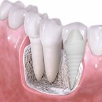 Zirkonyum Seramik İmplant Nedir?